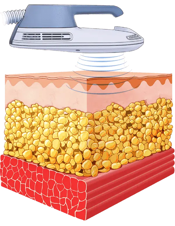 How Emsculpt NYC Works During Treatment Diagram