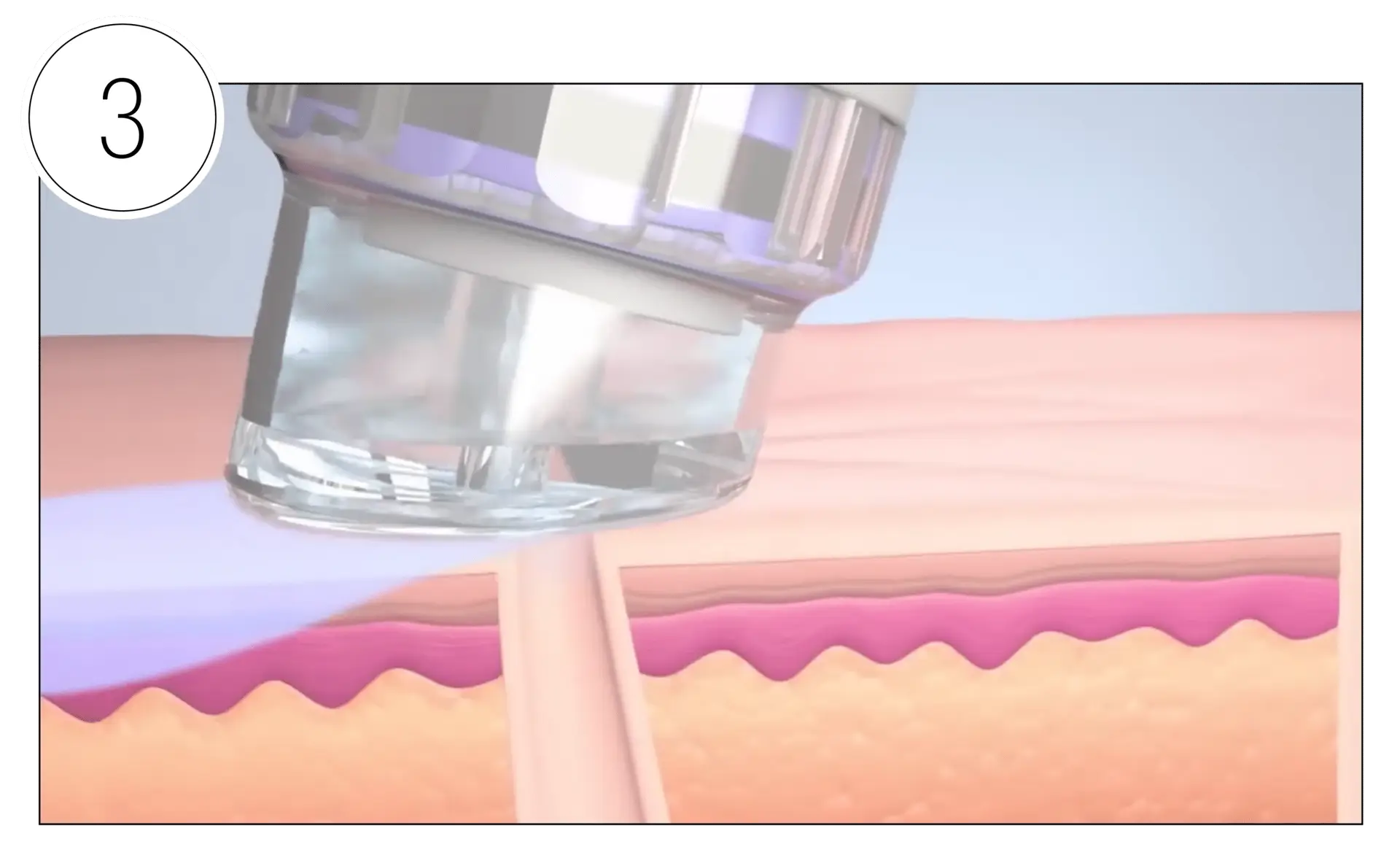 Skinney Medspa Treatments